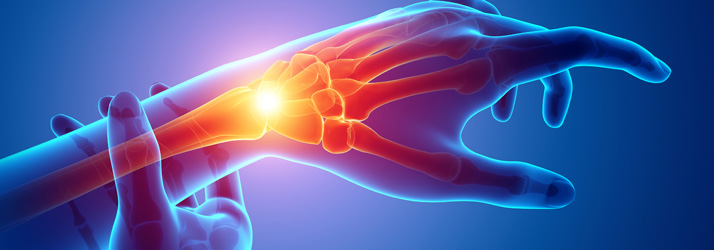 Tips to Manage Carpal Tunnel Syndrome Effectively in West Seattle WA